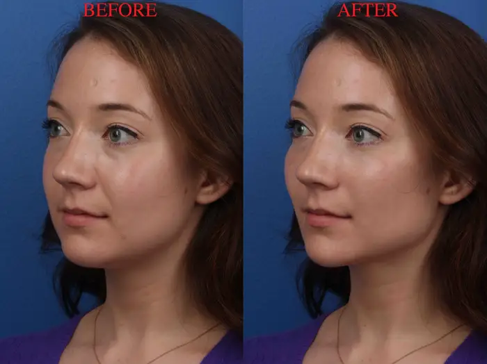 Facial Plastic Surgery