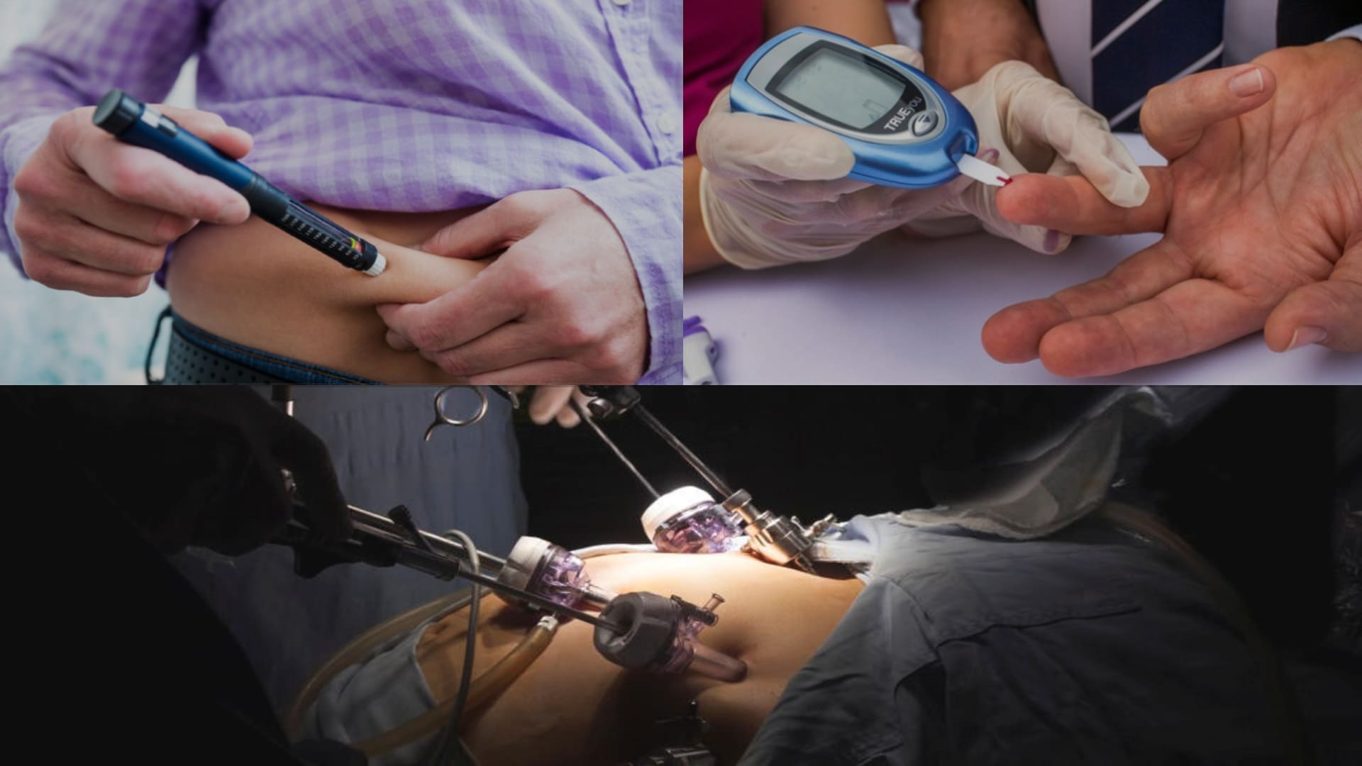 Metabolic Surgery