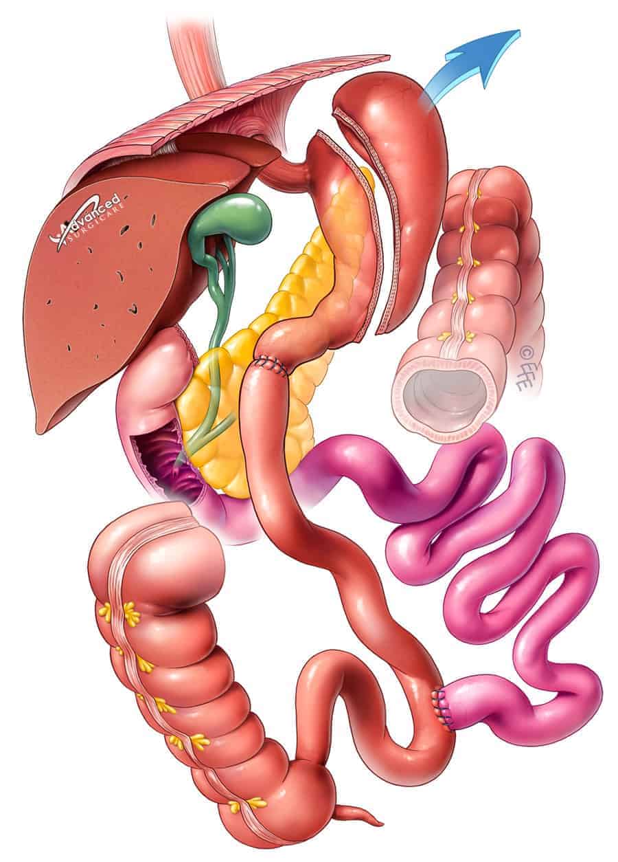 Bilio-pancreatic Diversion