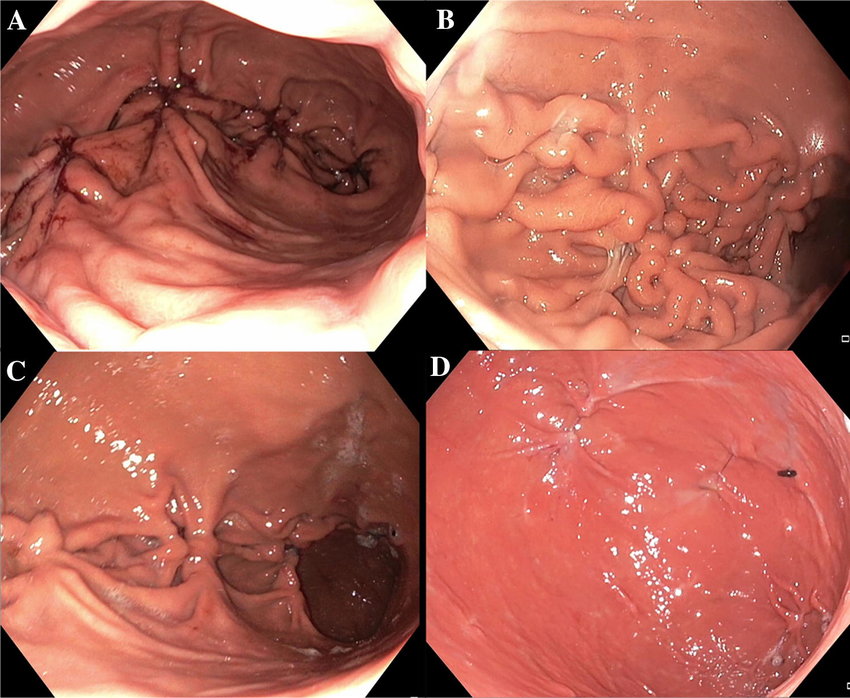 Endoscopic Bariatric Surgery