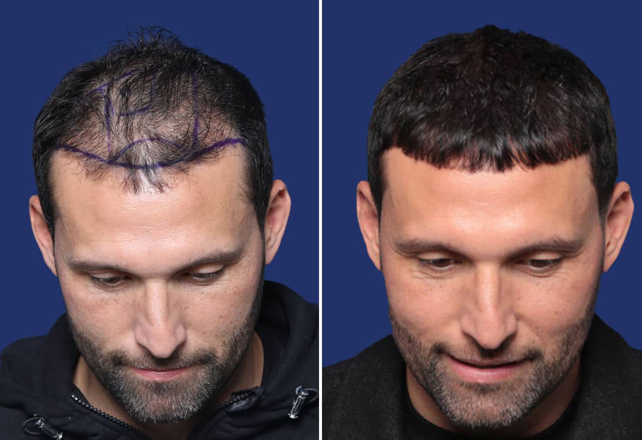 Hair Transplantation