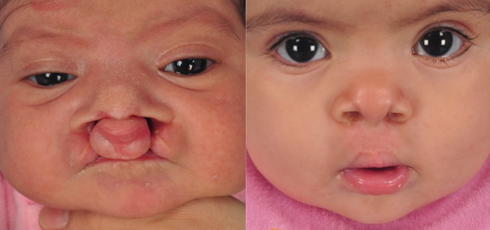 Cleft Lip and Palate Surgery