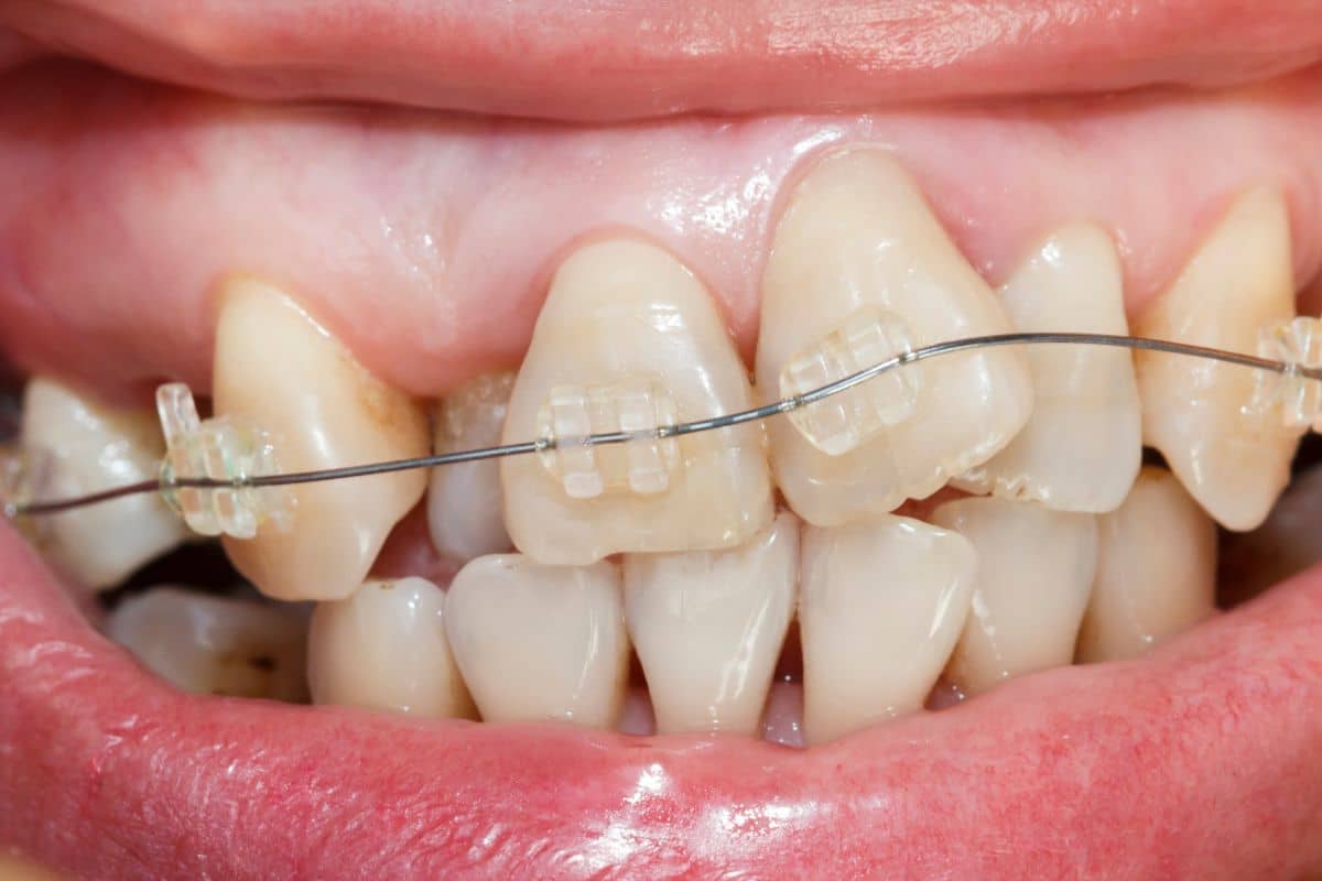 Misaligned teeth requiring orthodontic treatment