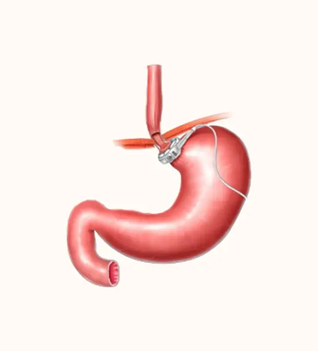 Laparoscopic Adjustable Gastric Banding (LAGB)