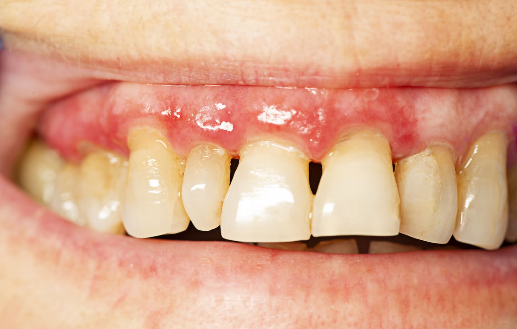 Gum diseases (periodontitis)