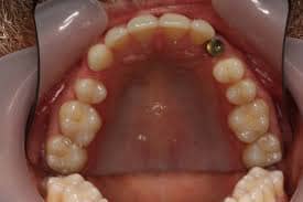 Missing teeth requiring dental implants