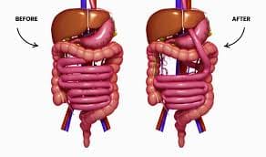 Gastric Bypass