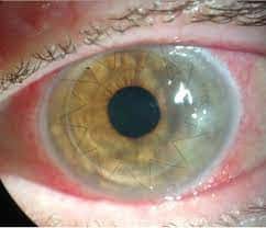 Corneal Transplantation