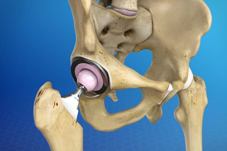 Joint Replacement