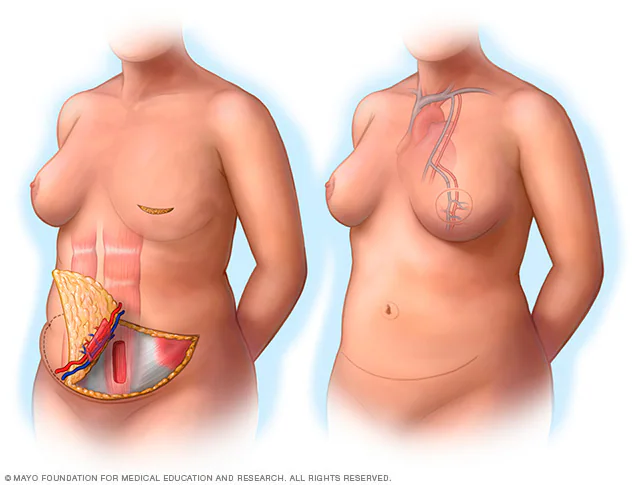 Breast Reconstruction