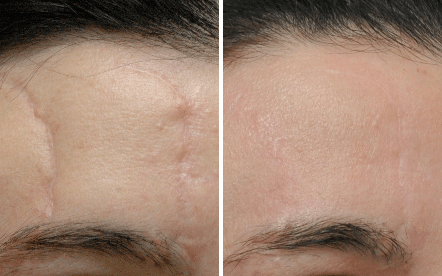 Scar Revision and Sclerotherapy