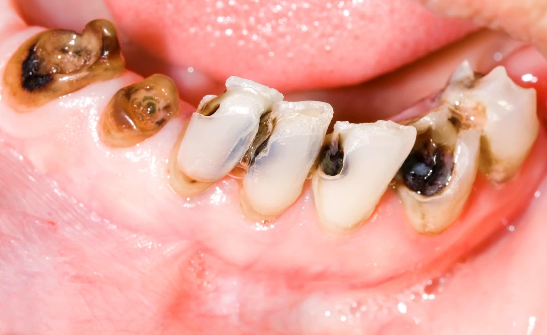 Tooth decay and cavities