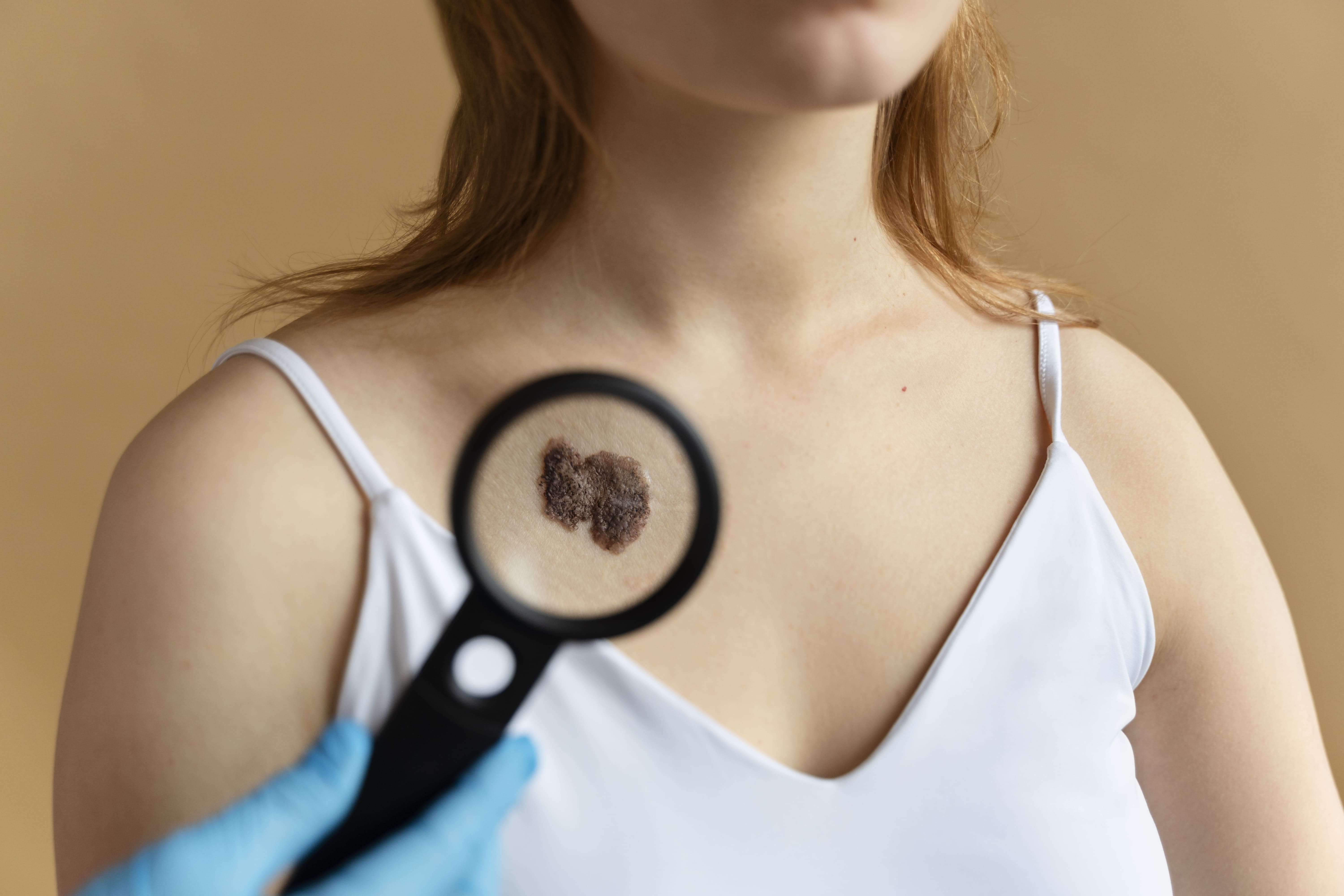 Mole and Skin Cyst Removal